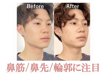 隆鼻矯正専門店 ラプリセレネ (Raplit Selene)の写真/鼻筋通ったイケメンへ！小顔矯正でフェイスラインもスッキリ◎清潔感UPで自信みなぎる♪