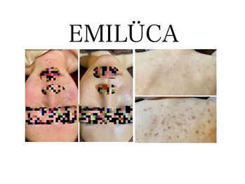 エミルカ(EMILUCA)/ハーブピーリング専門店です♪