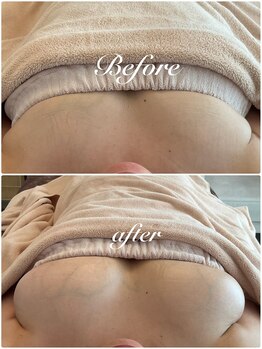 美バストアルファ(美bust α)/【バストアップ】症例