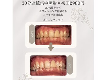 プラスビーセルフ(+b self)/ホワイトニングビフォーアフター