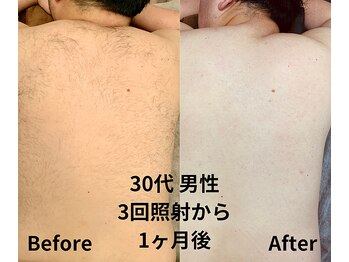 バディーズ(BUDDieS)/30代 男性 3回目から1ヶ後の状態