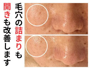 エリン(ERIN)/毛穴徹底洗浄×レチノールピール