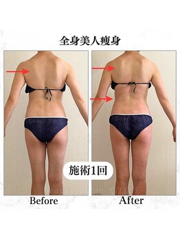 リルチェ 自由が丘(RILUCE)/全身美人痩身効果写真