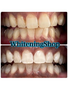 ホワイトニングショップ 山形店(Whiteningshop)/タバコと食べ物制限無し！