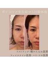 ナナイロ(nanairo)/ポテンツァ×エクソソーム