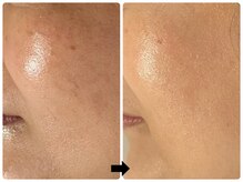 エフェクト 塚口店(effect)/Before After &nbsp;&nbsp;40代/3回目