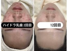 【リピ多数★】脱！いちご鼻！ハイドラ洗浄&ヒト乳歯幹細胞導入