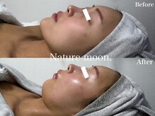 ナチュールムーン(Nature moon.)/ハーブピーリング