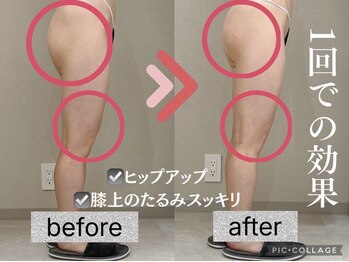 イヨヨ(iyoyo)/【痩身】Before After