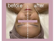 プルミエプラス 恵比寿店(PREMiER+)/【恵比寿/渋谷/小顔/たるみ】