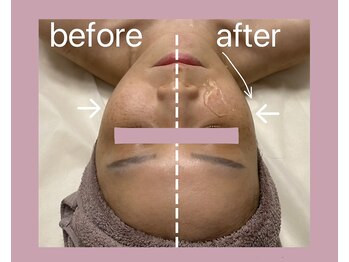 プルミエプラス 恵比寿店(PREMiER+)/【恵比寿/渋谷/小顔/たるみ】