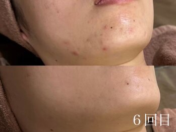 ホワイトアクア 京都店(WHITE AQUA)/ハーブピーリング/毛穴/京都