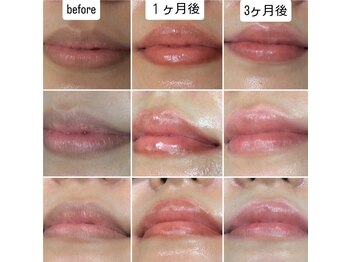 ミラージュ(mirage)/ローマピンク