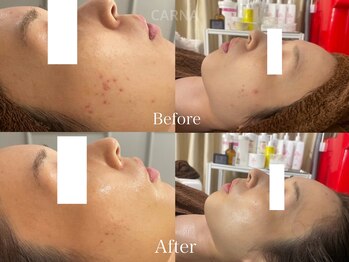 カルナ(CARNA)/【肌質改善専門店】CARNA