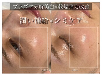 ラ ドゥーサ(La Dusa)/プラズマ分解美白NMNブースター