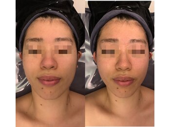 ナラビューティー(NARA BEAUTY)/コルギ