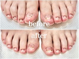 劇 的☆深爪矯正！Before→After