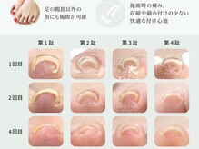 カリス(Charis)/巻き爪でお悩みの方に！