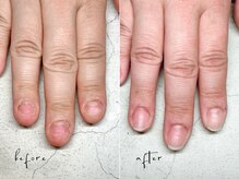 ユユネイル(yuyu nail)/【深爪育成】1ヶ月経過