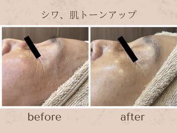 アンダブル(Andouble)/ビフォーアフター(幹細胞使用)