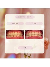 プラスビーセルフ(+b self)/ホワイトニングビフォーアフター