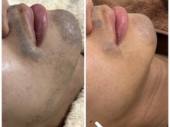 エミュ(emu)/メンズ髭脱毛の効果絶大毛穴レス