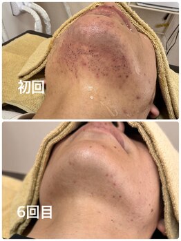 ティアレ 緑井店(Tiare)/W照射 ひげ脱毛