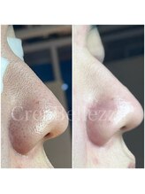 クレアベレッツァ(Crea Bellezza)/メンズ/黒ずみ/ザラつき