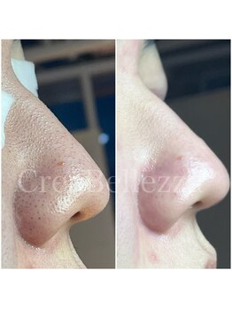 クレアベレッツァ(Crea Bellezza)/メンズ/黒ずみ/ザラつき