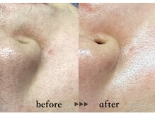 ソーヴ(SOLVE)/松ヤニワックス脱毛/黒ずみ毛穴