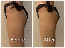 ソルニス(Solnis.)/痩身☆脂肪分解/ハイパーナイフ