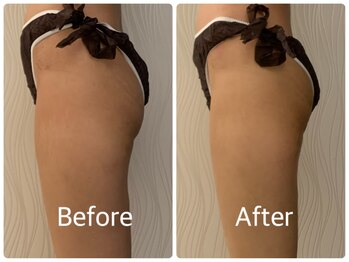 ソルニス(Solnis.)/痩身☆脂肪分解/ハイパーナイフ