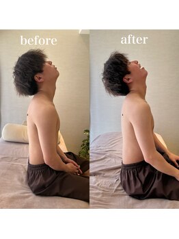 ハリノヒ 大阪院/ストレートネック改善鍼灸整体