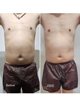 ラクト サロン(RAKT salon)/脂肪冷却4カップ 脇腹 上下腹部