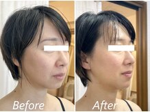 ドクターボディ 新宿店(Dr.Body)/【人中短縮/リフトアップ 40代】