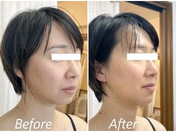 ドクターボディ 新宿店(Dr.Body)/【人中短縮/リフトアップ 40代】