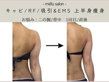 ミエル(mielu)/選べる痩身　二の腕　3回