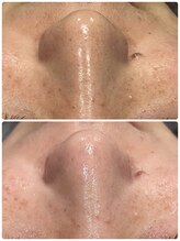 トータルビューティーサロン ヴィヴィエ(ViVier)/ハイドロフェイシャル症例1回