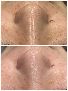 トータルビューティーサロン ヴィヴィエ(ViVier)/ハイドロフェイシャル症例1回