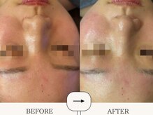 ハイフン(HIFUN)/ゆらぎ肌敏感肌★毛穴ニキビケア