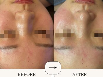 ハイフン(HIFUN)/ゆらぎ肌敏感肌★毛穴ニキビケア