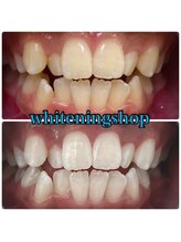 ホワイトニングショップ 山形店(Whiteningshop)/バイト前にホワイトニング