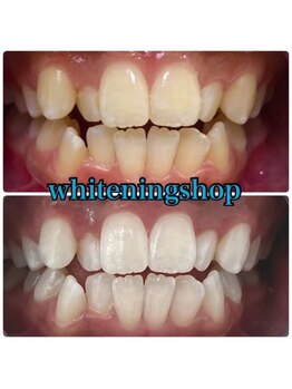 ホワイトニングショップ 山形店(Whiteningshop)/バイト前にホワイトニング