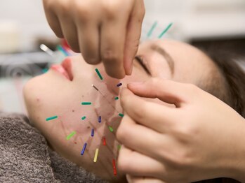 ヴィーライン 大阪梅田院(VeLine)の写真/素肌が変わる・表情が変わる!美容鍼が引き出す本来のあなたの美しさ《形状記憶美容鍼¥6600》