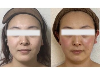 マーリィズエステティック(MARLEY'S AESTHETIC)/小顔たるみケアサークルショット