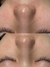 韓国肌管理室ハナ(hana)/肌質改善/毛穴洗浄/毛穴洗浄大阪