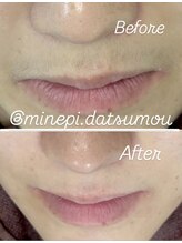 ミンエピ(MinEpi)/顔脱毛ビフォーアフター♪