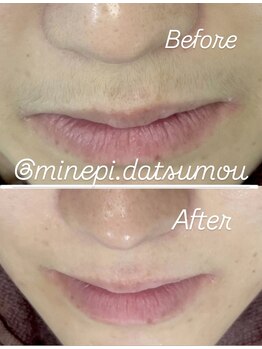 ミンエピ(MinEpi)/顔脱毛ビフォーアフター♪