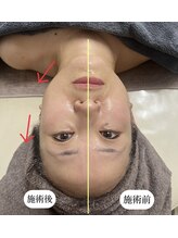 ミヤビ(MIYABI)/１回の施術結果