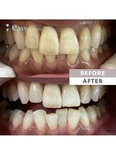 イージーホワイトニング 神戸三宮店(easy whitening)/お客様の症例写真です★
